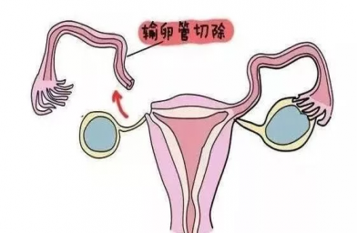 吉林慈铭博鳌国际医院三代试管婴儿，切除双侧输卵管还能做试管婴儿吗？