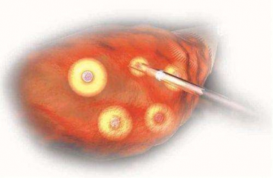 吉林格鲁吉亚Innova医院专家解释促排卵有几种方式？
