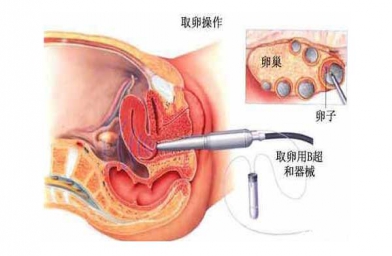 吉林“二孩政策”致浙江试管婴儿激增，但费用和成功率不成正比